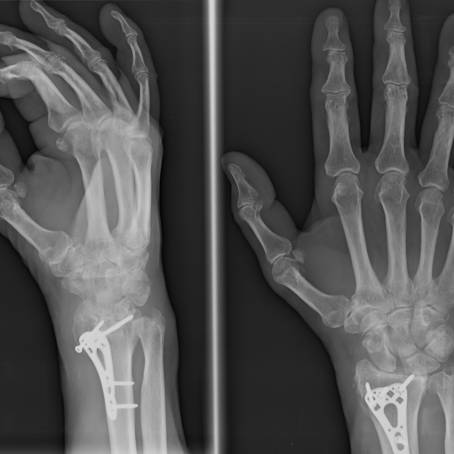 Radiographic Image of Adult Females Hand